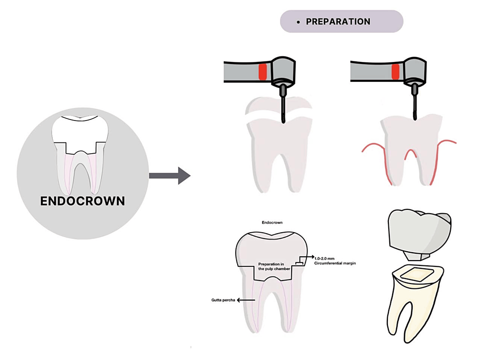 Endocrowns Indications, Preparation Techniques, and Material Selection