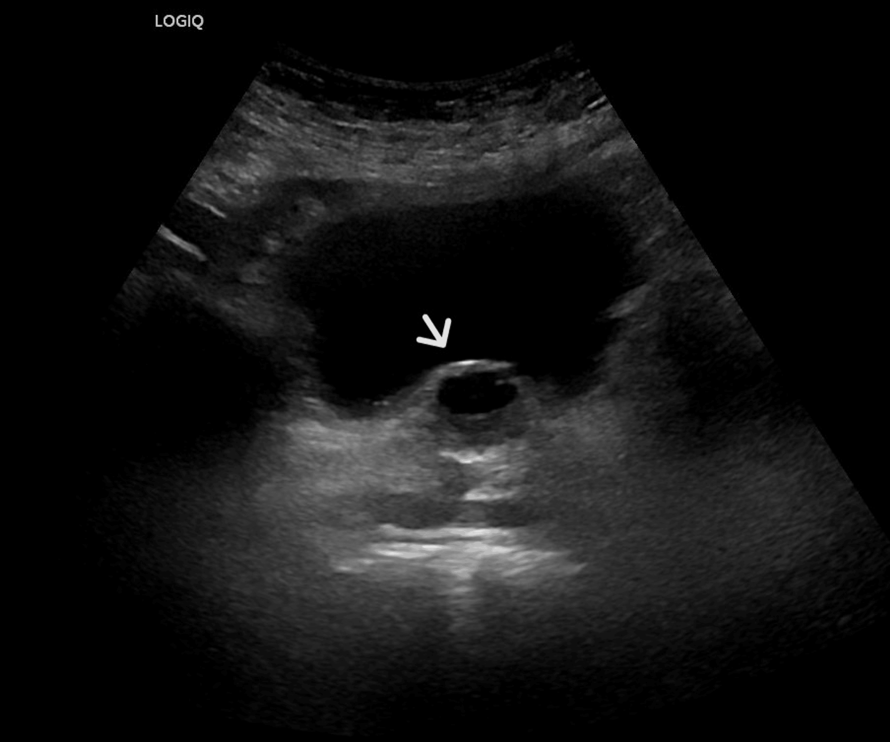 Development Of A Prostatic Urethral Cyst After Rezum Causing Persistent Lower Urinary Tract 6699