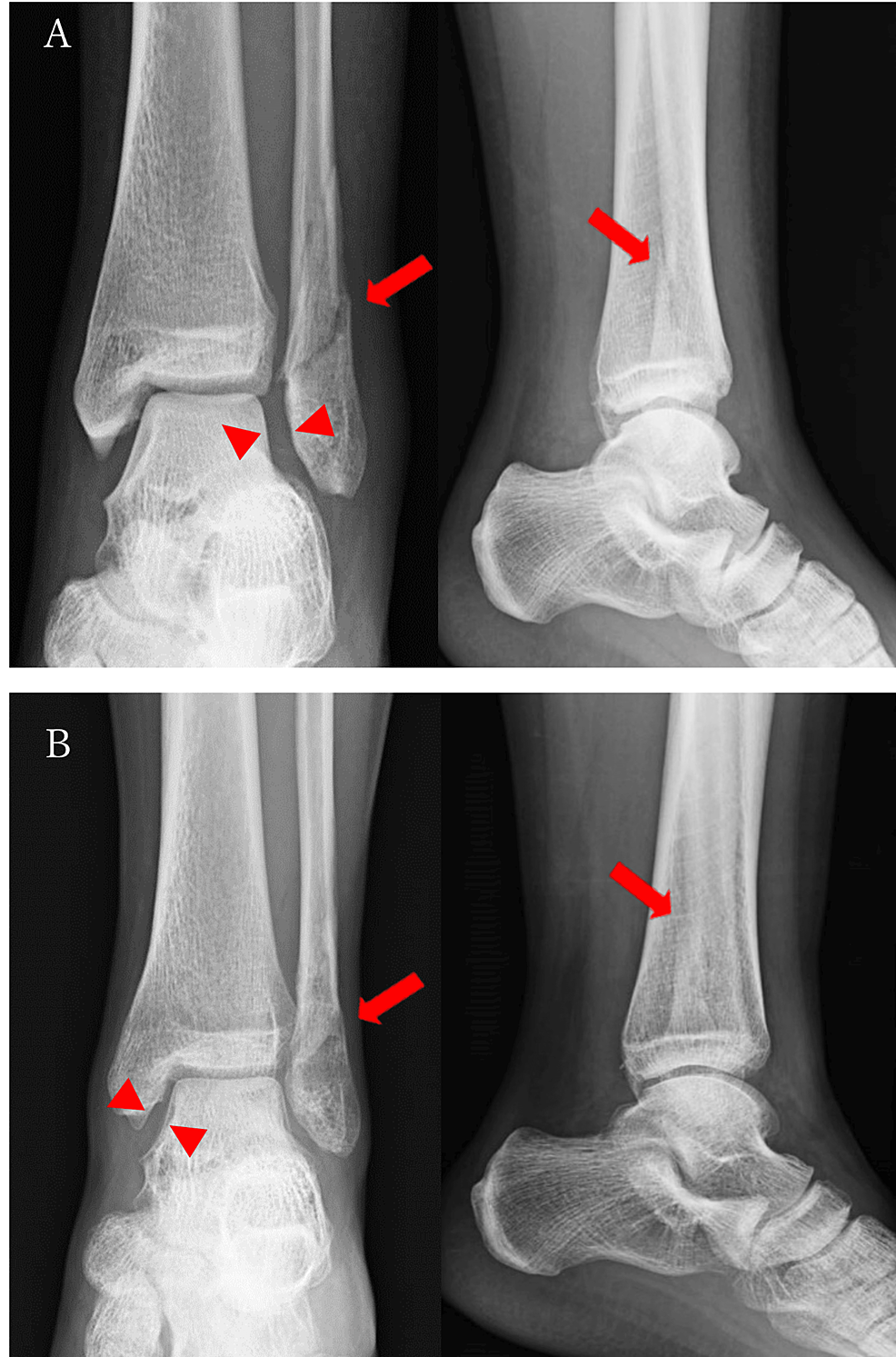 Dolor residual medial del tobillo tras consolidación tardía de una fractura de maléolo lateral: reporte de un caso