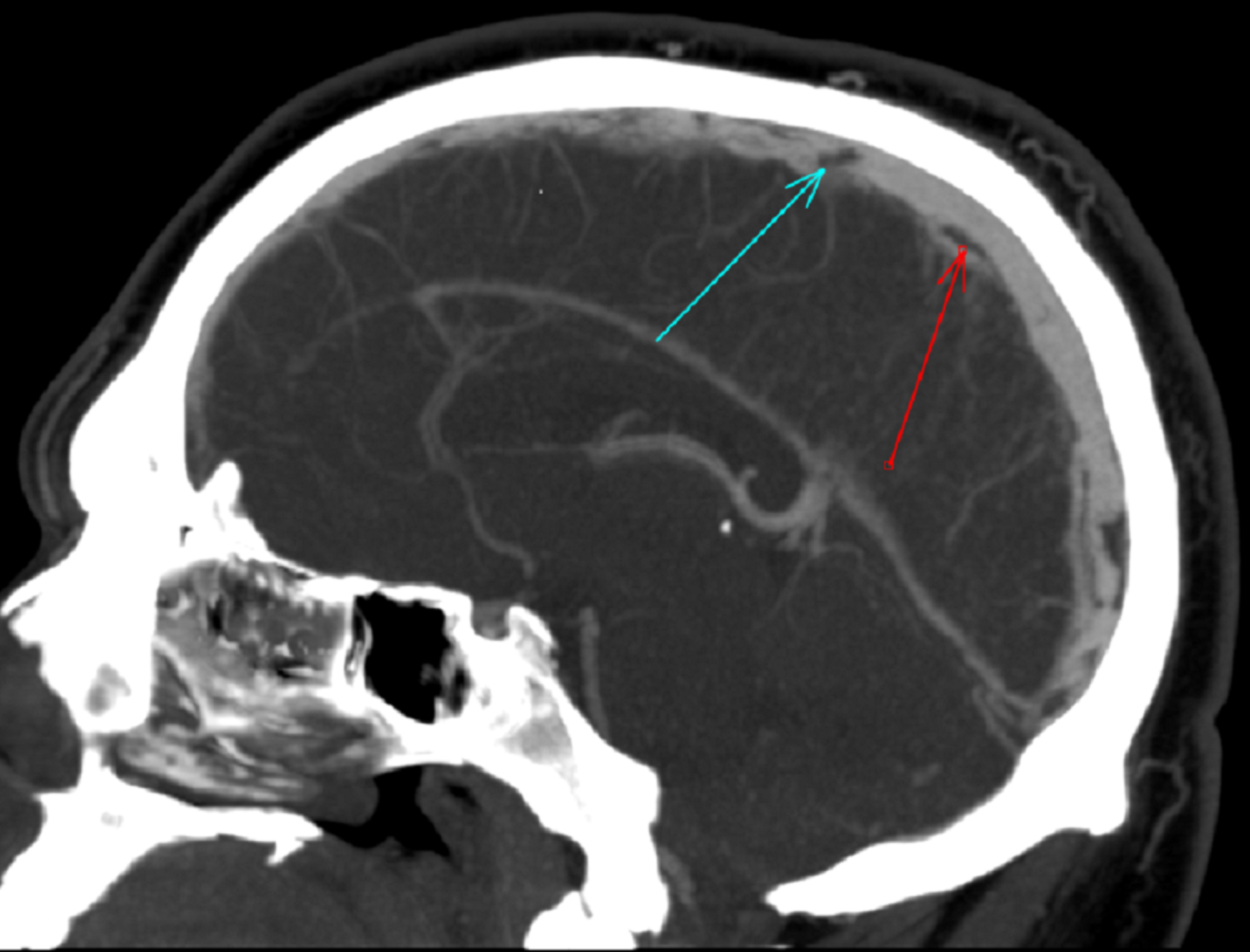 Inferior Sagittal Sinus Thrombosis 7509