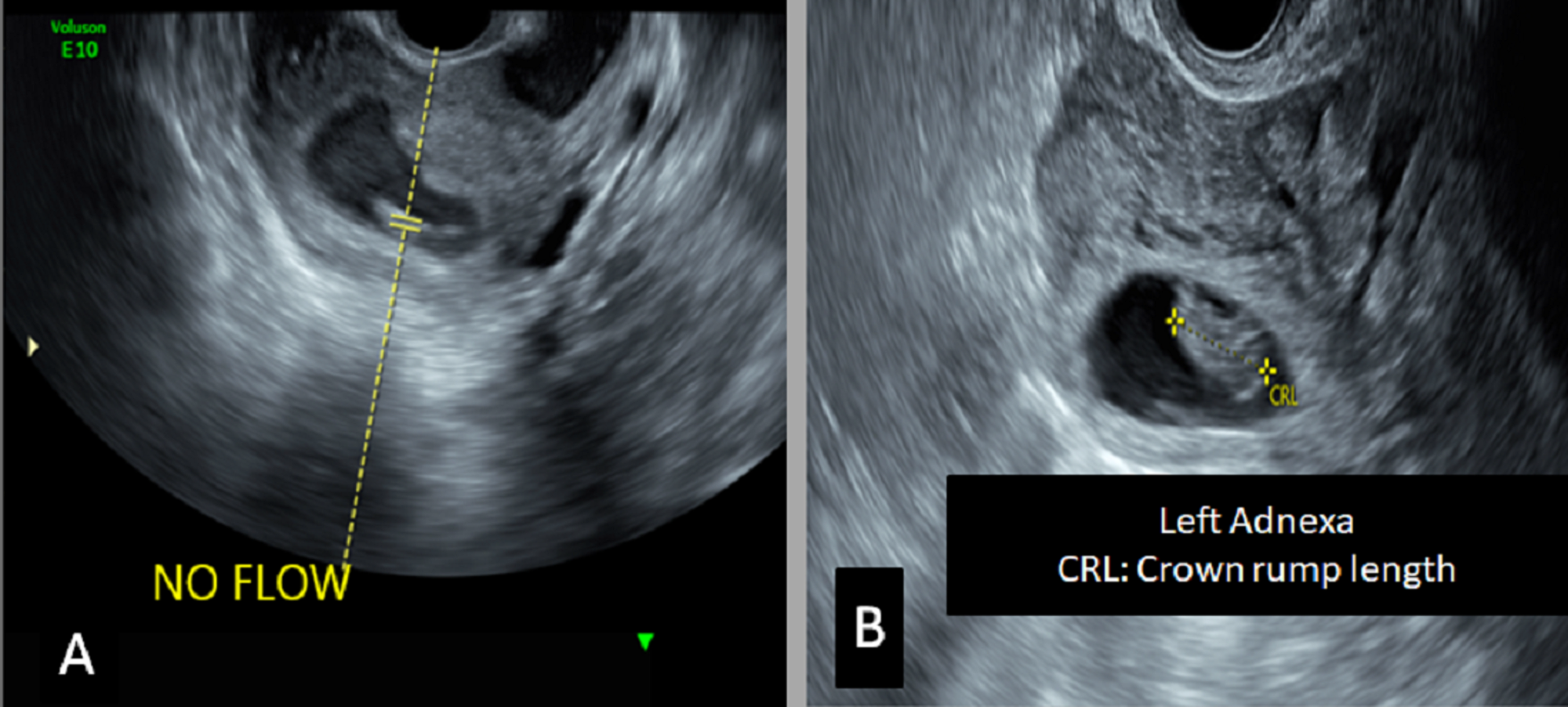 Cureus Heterotopic Pregnancy A Diagnostic Challenge Six Case