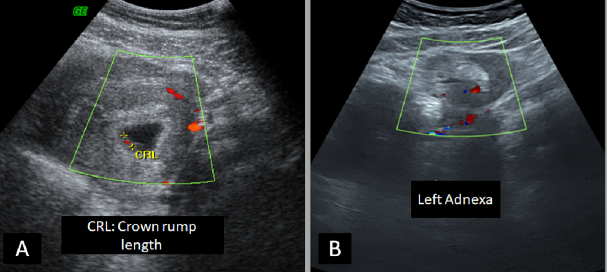 Cureus Heterotopic Pregnancy A Diagnostic Challenge Six Case