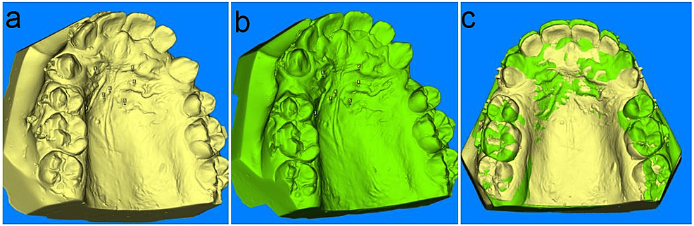 Cureus, Clinical Evaluation of Single Versus Repeated  Micro-Osteoperforations During Orthodontic Canine Retraction: A Randomized  Clinical Trial