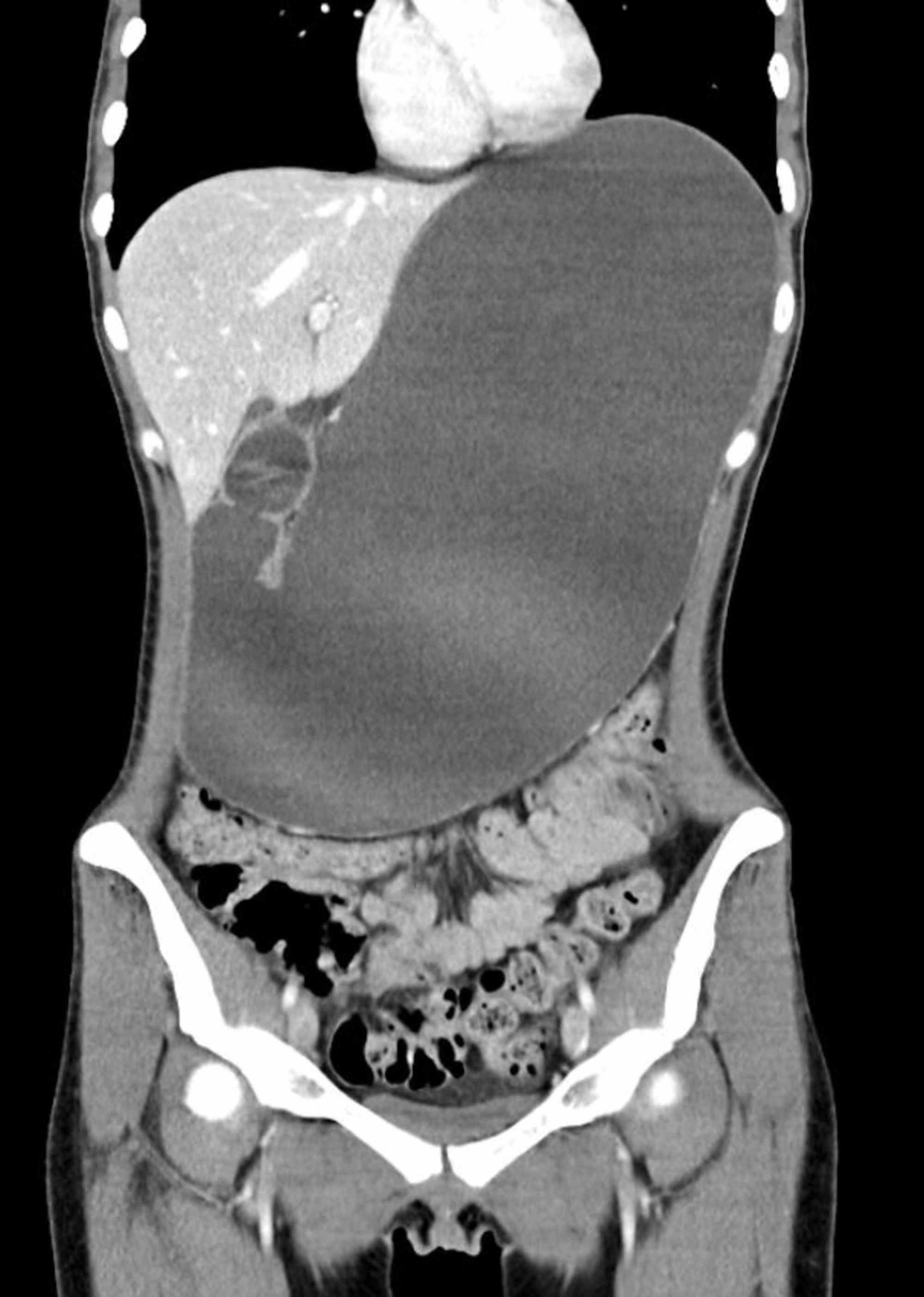 Cureus Superior Mesenteric Artery Syndrome Secondary To Anorexia Nervosa And Methamphetamine Use