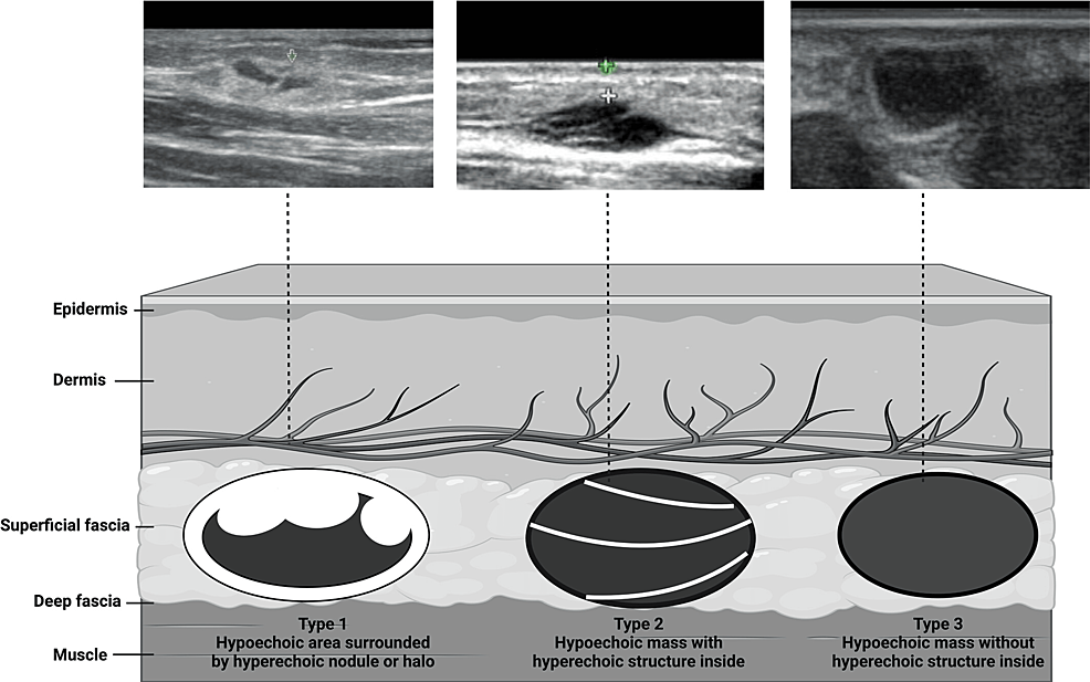 Illustration of the SAH classification categories from Nayak et al