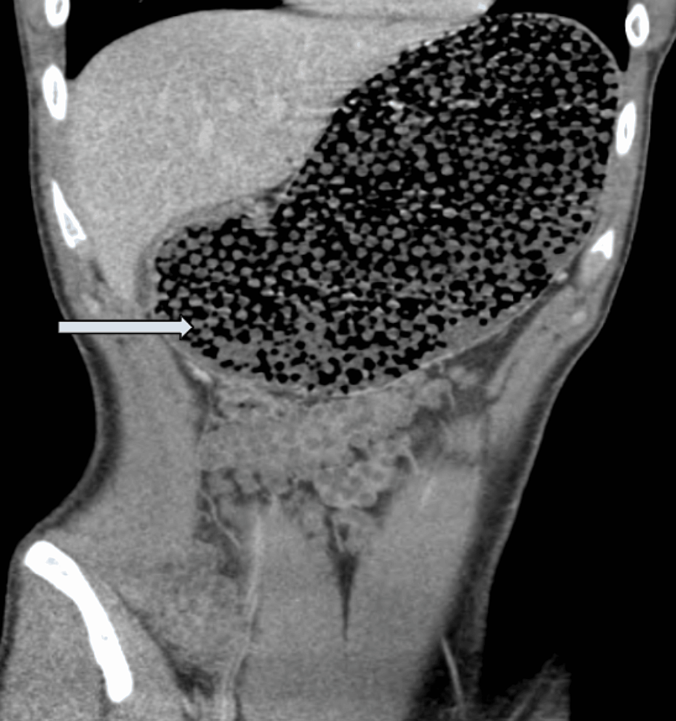 The Gastric Obstruction Due to Orbeez Beads Ingestion A Case Report