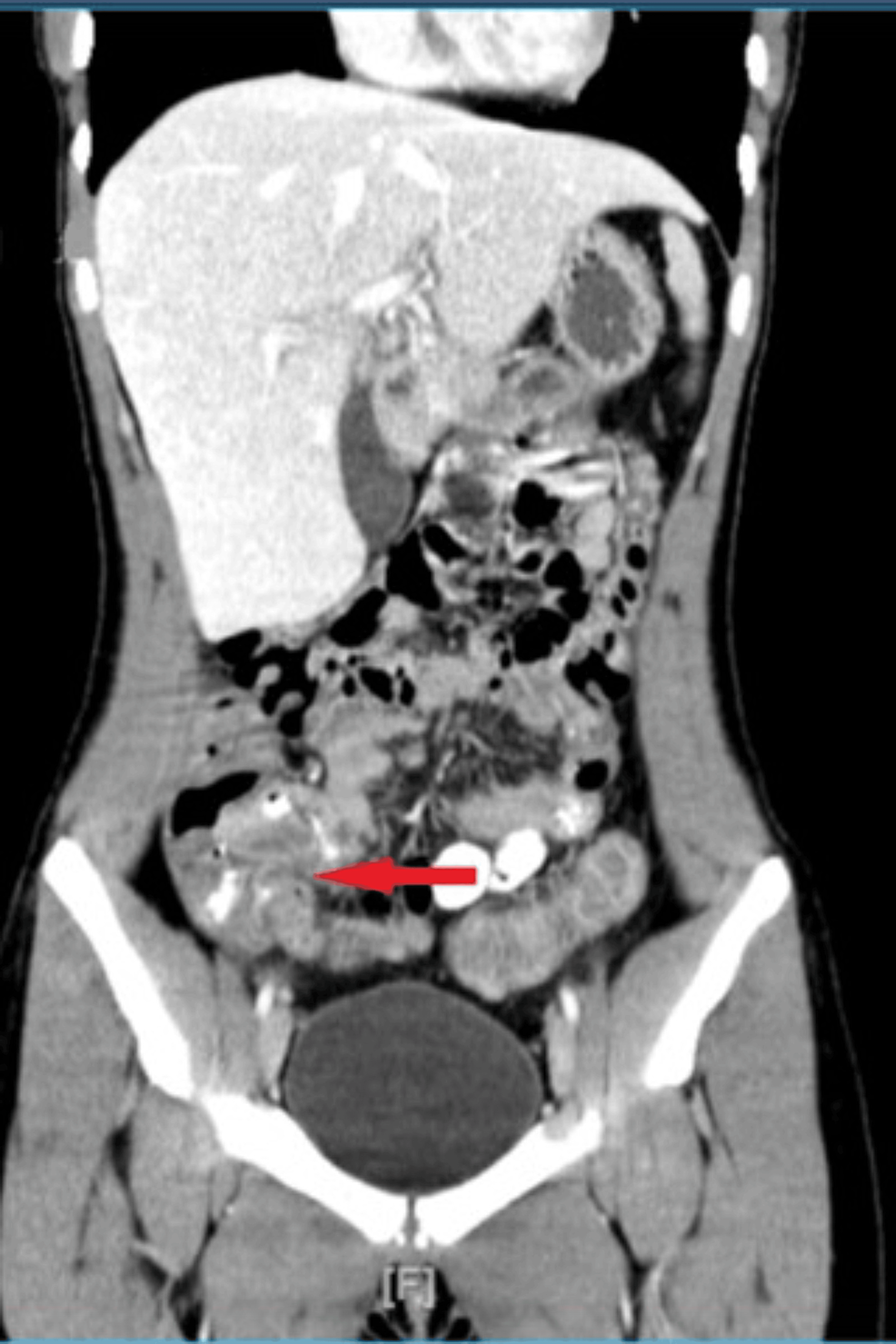Cureus Salmonella Group B Ileitis Mimicking Crohn's Disease A Case