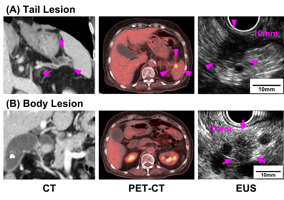 Distinct Genomic Profiles of Two Small Malignant Lesions Associated With an Intraductal Papillary Mucinous Neoplasm Co-occurring in a Patient