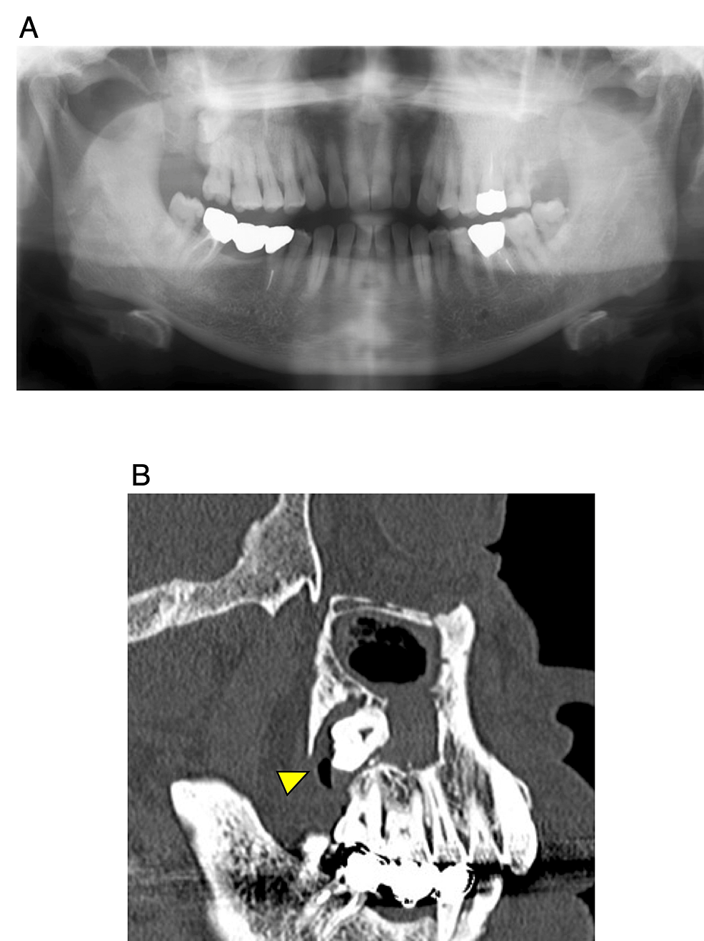 cureus-a-case-of-a-dentigerous-cyst-in-the-maxillary-sinus-treated