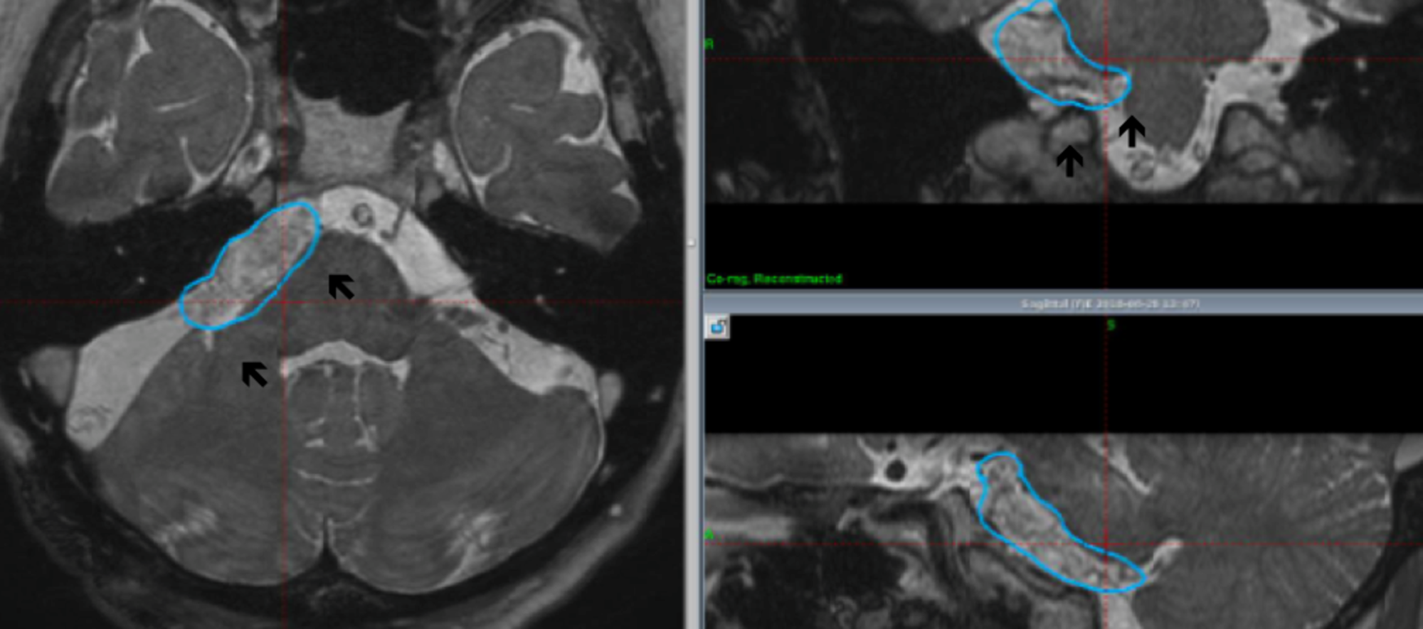 Cureus | Radiosurgery for Epidermoid Tumors: Dramatic Pain ...