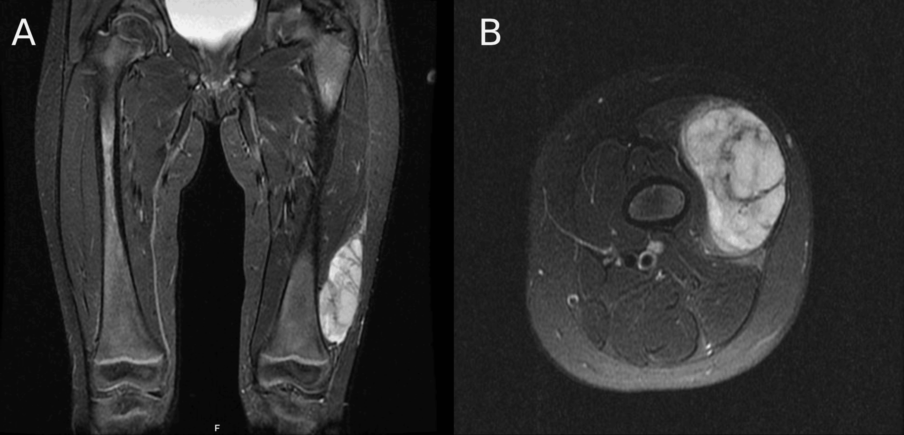 KIAA1549BRAF Gene Fusion Spindle Cell With Infantile