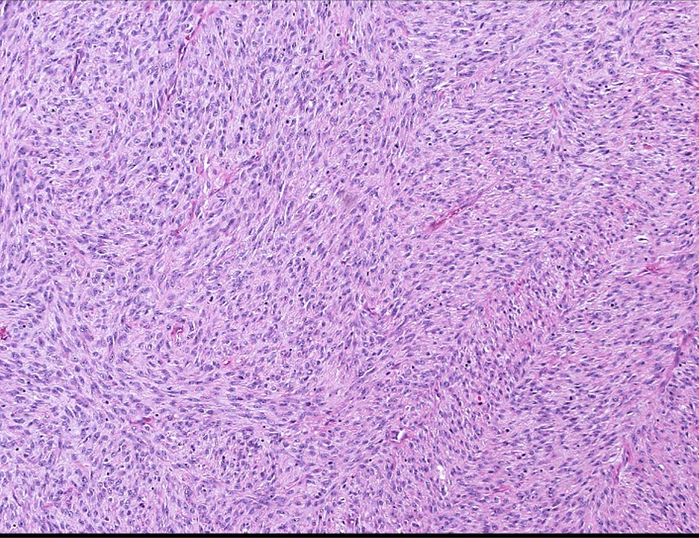 KIAA1549BRAF Gene Fusion Spindle Cell With Infantile Pattern in a