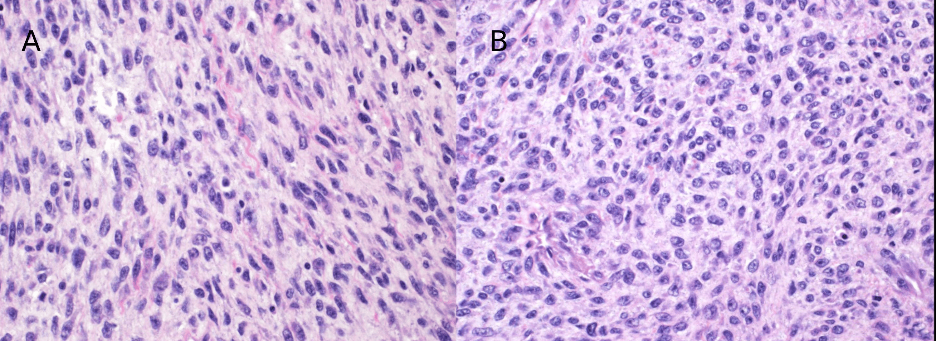KIAA1549BRAF Gene Fusion Spindle Cell With Infantile