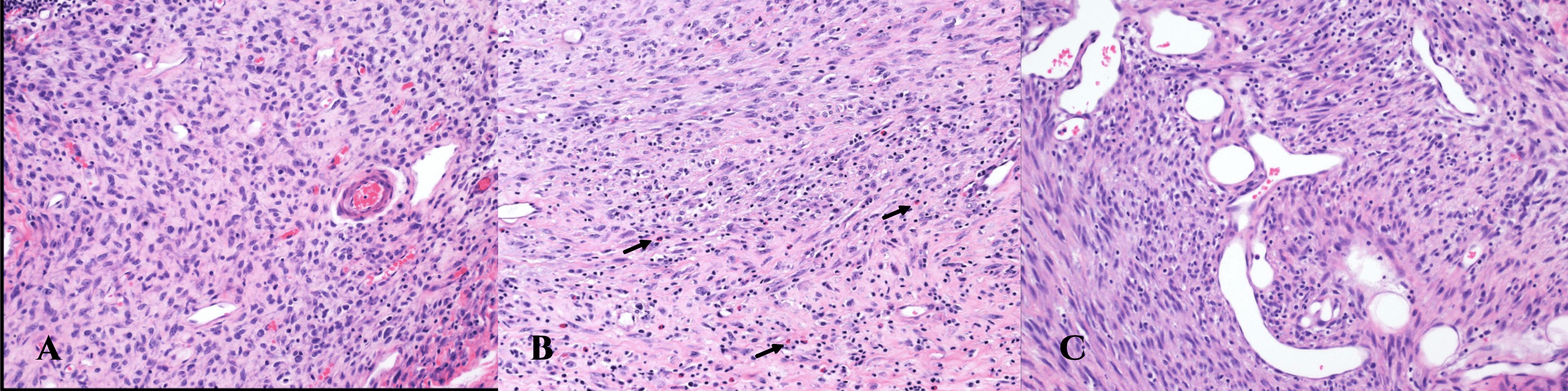 KIAA1549BRAF Gene Fusion Spindle Cell With Infantile