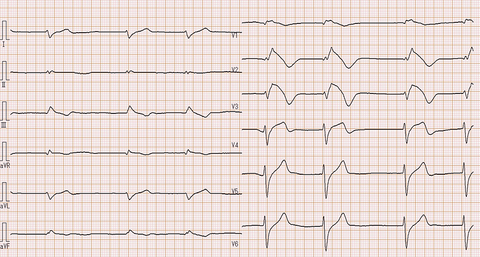 Cureus | Pilsicainide Toxicity-Induced Brugada-Like ST Segment ...