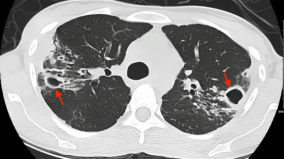Cureus Mycobacterium avium Complex Pulmonary Infection in a Patient