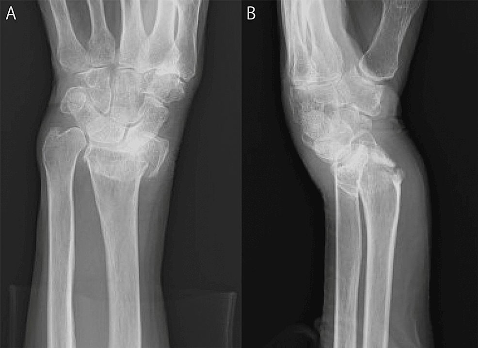 Pediatric Colles Fracture, Pediatric Radiology Reference Article, Pediatric Imaging