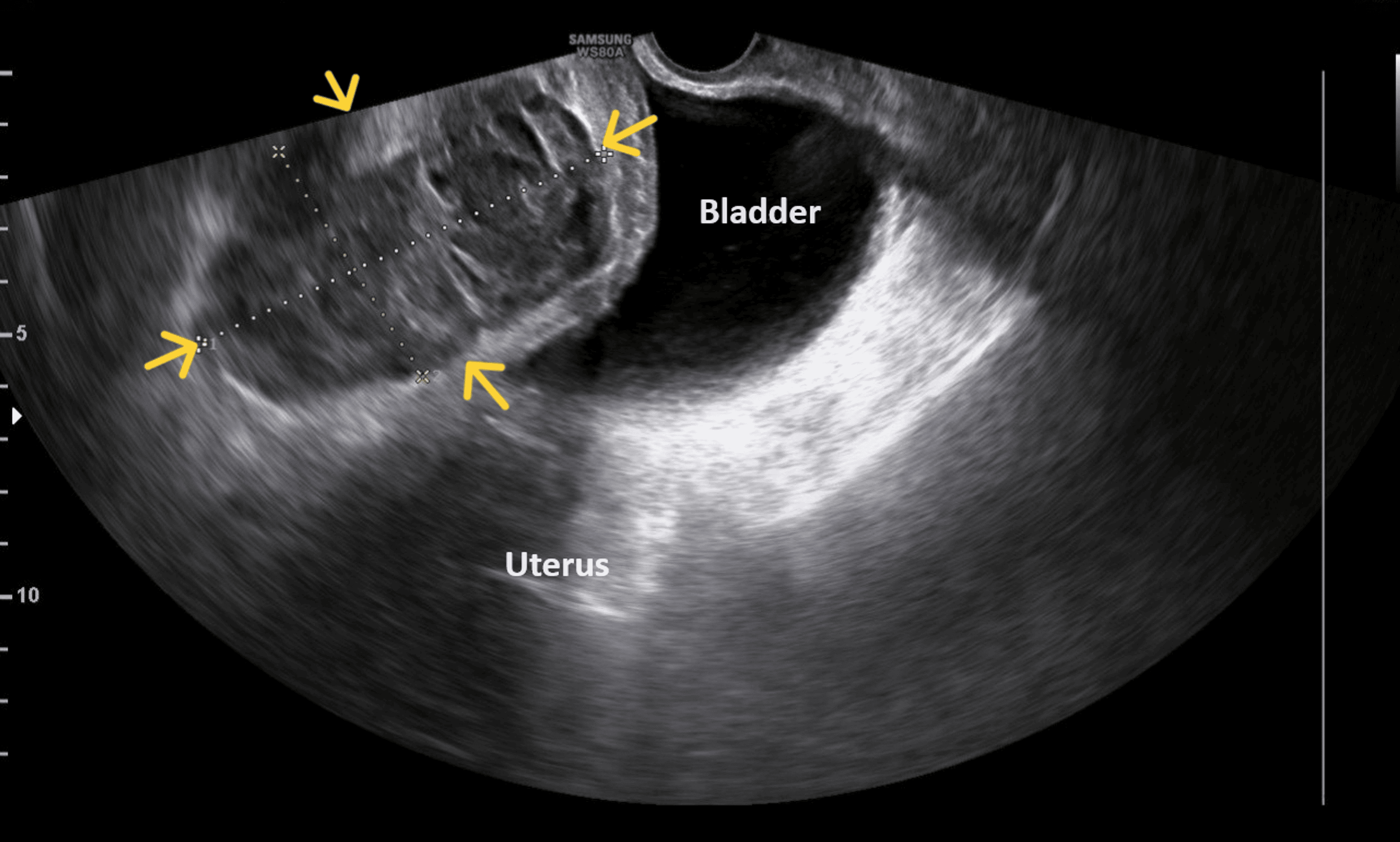 Cureus Surgical Treatment of a Large Postcesarean Hematoma in the Retzius Space