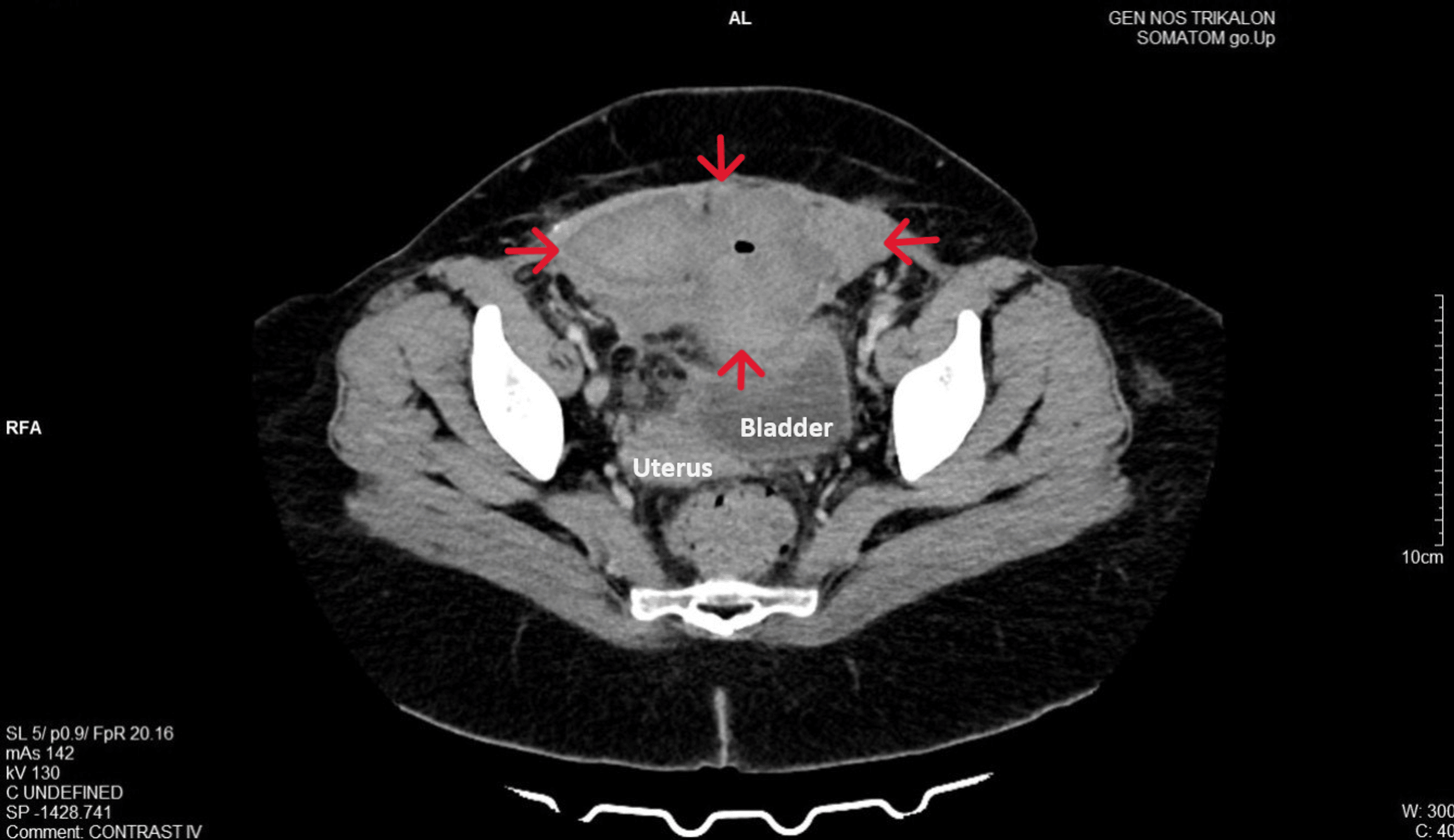 Cureus Surgical Treatment of a Large Postcesarean Hematoma in the Retzius Space