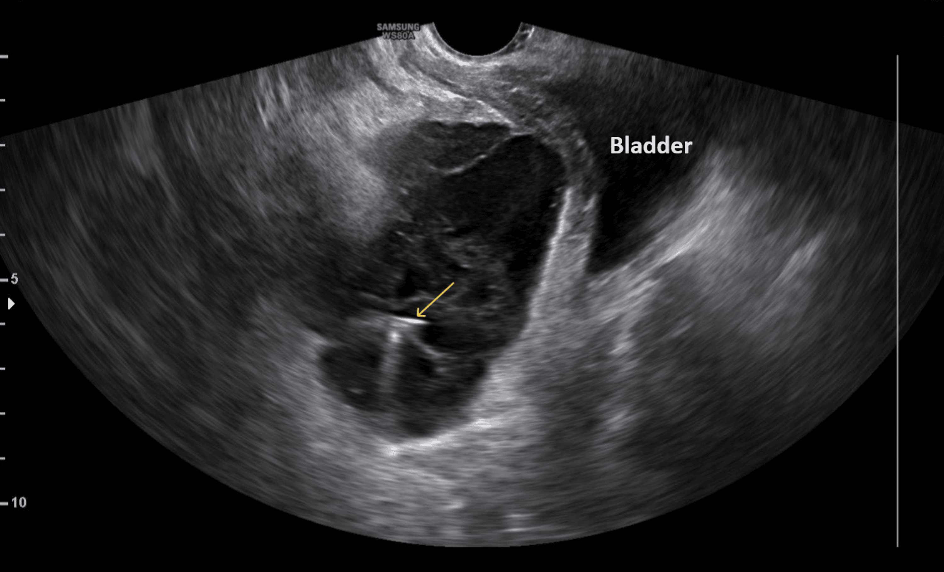 Cureus Surgical Treatment of a Large Postcesarean Hematoma in the Retzius Space