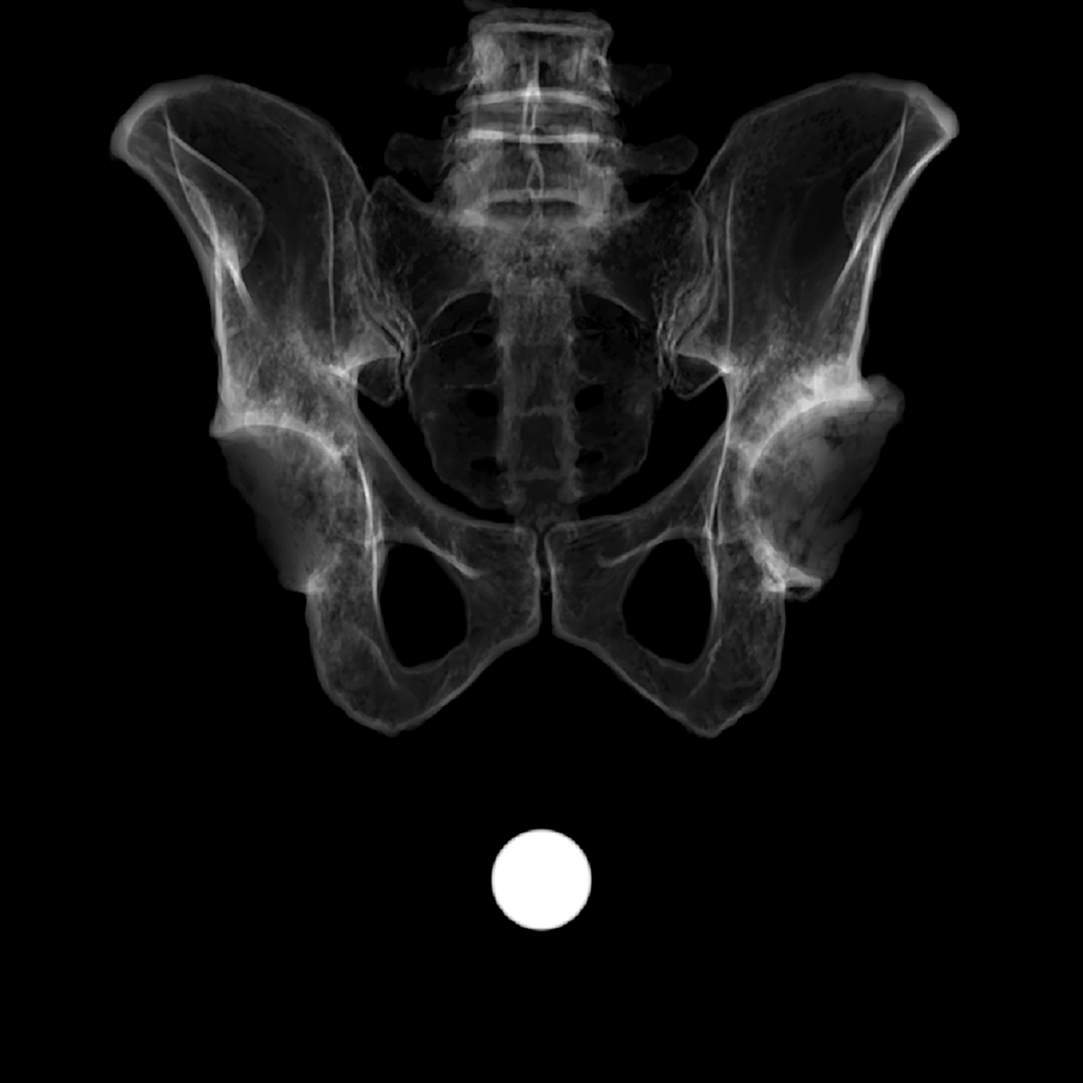 Cureus A Novel Method for Correcting Pelvic Tilt on Anteroposterior