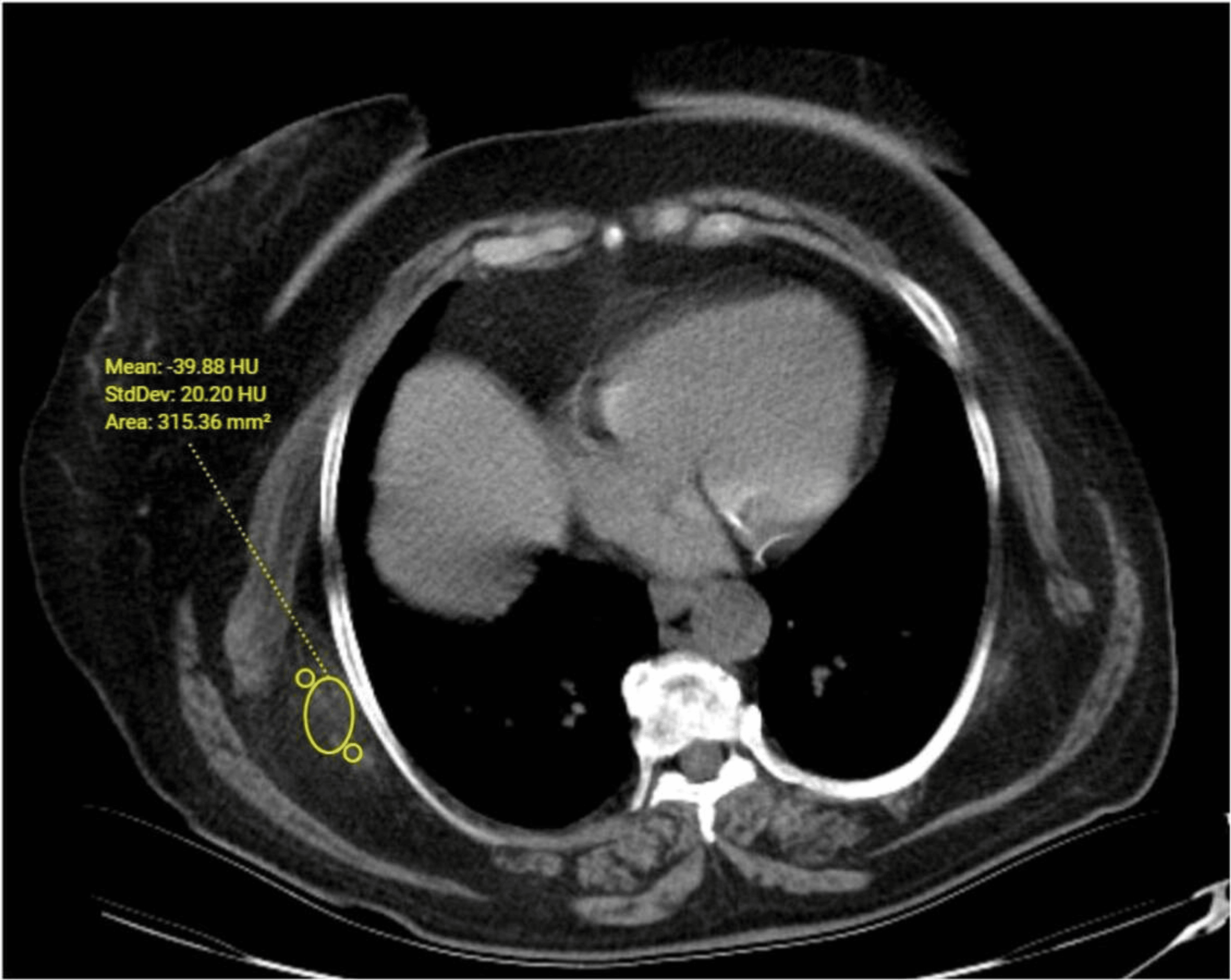 Elastofibroma Dorsi Detected Incidentally On Chest Computed Tomography