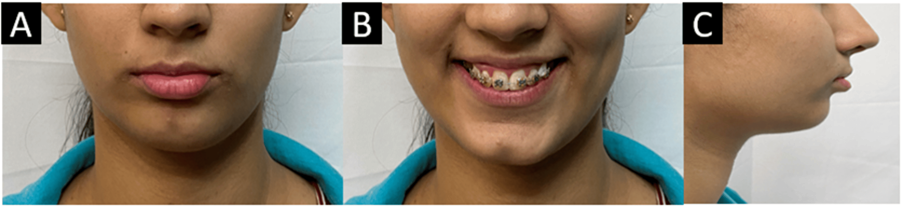 Cureus Simultaneous Intrusion and Retraction of Maxillary Anterior