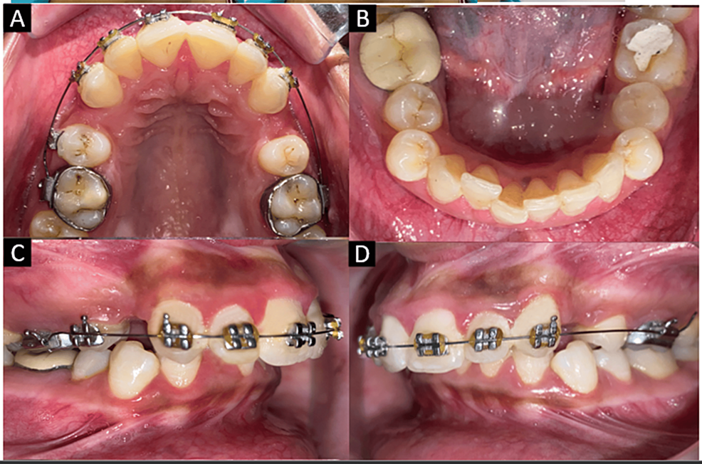 Cureus Simultaneous Intrusion and Retraction of Maxillary Anterior