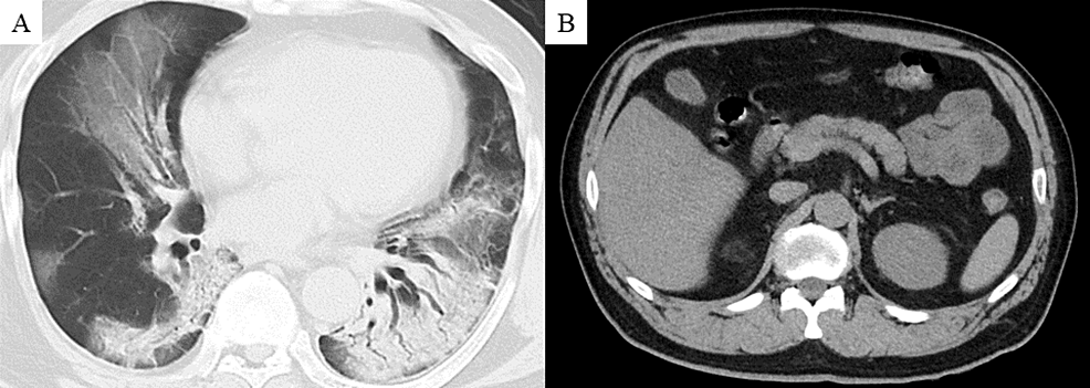 Cureus Infected Walled Off Necrosis Following Covid Associated