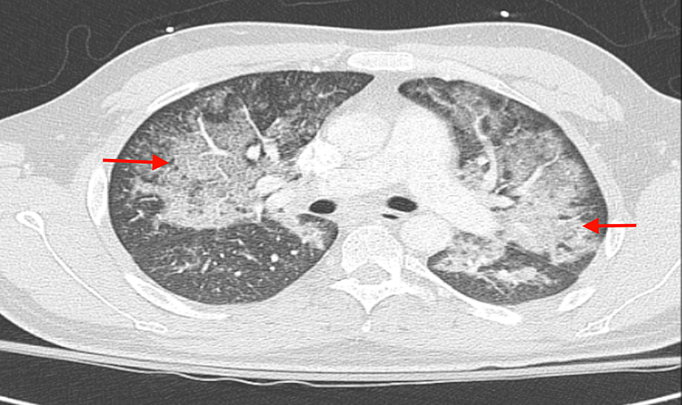 elfbar elfa master akku Vaping is a risk factor for spontaneous pneumothorax: Two cases