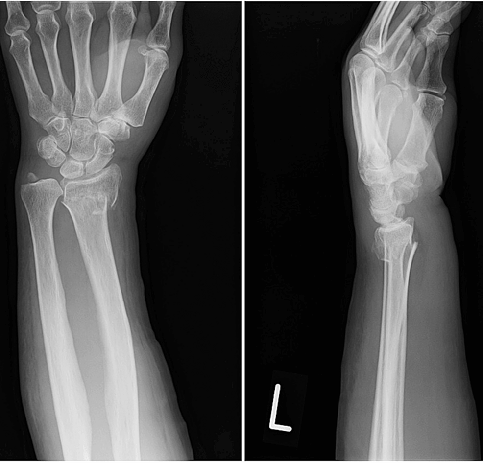 Low-Intensity Pulsed Ultrasound for Delayed Union of Distal Radius ...