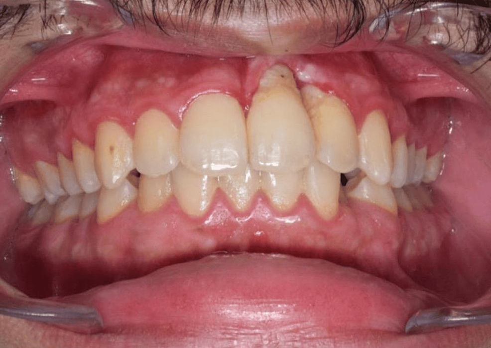 Cureus | morphea involving the lips and gingiva: a rare case report