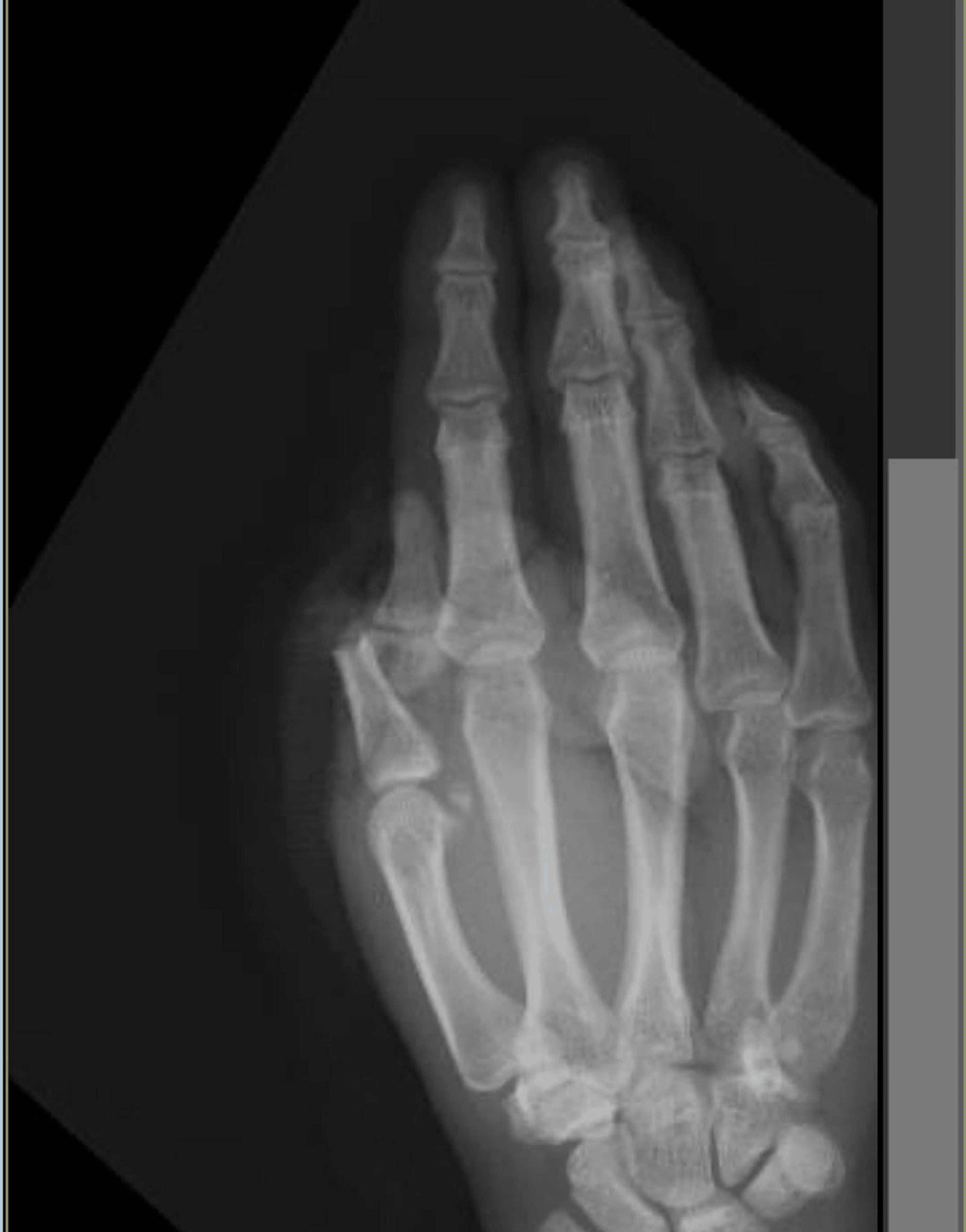 Cureus Spiral WrapAround Technique in the Reverse Radial Artery