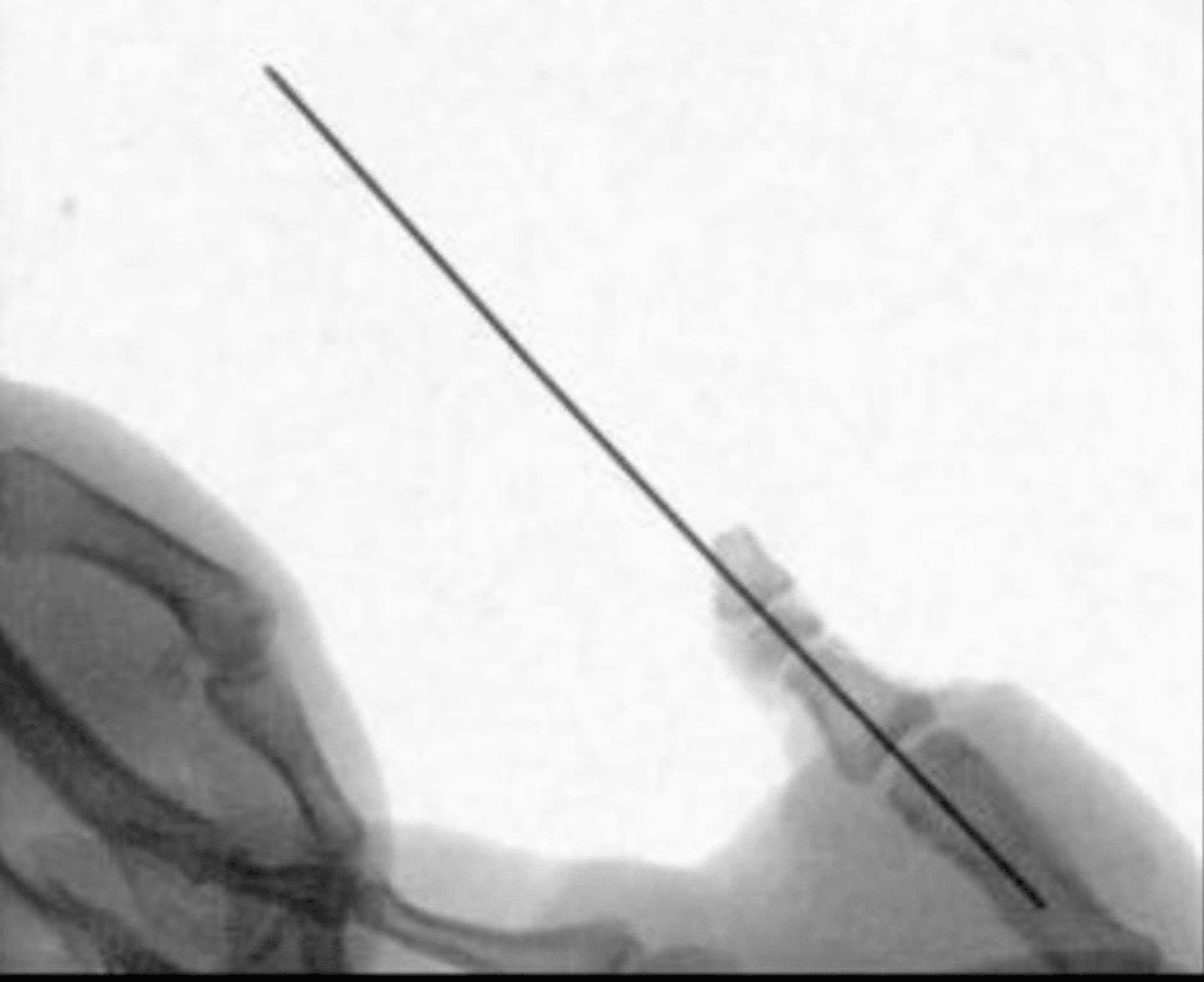 Spiral WrapAround Technique in the Reverse Radial Artery