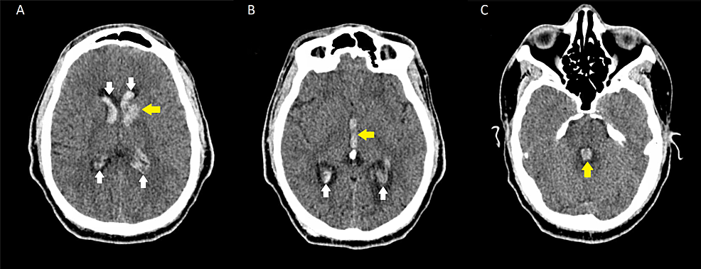 Cureus, Brainstem and Spinal Arachnoiditis Ossificans Associated With  Neurocysticercosis: A Case Report