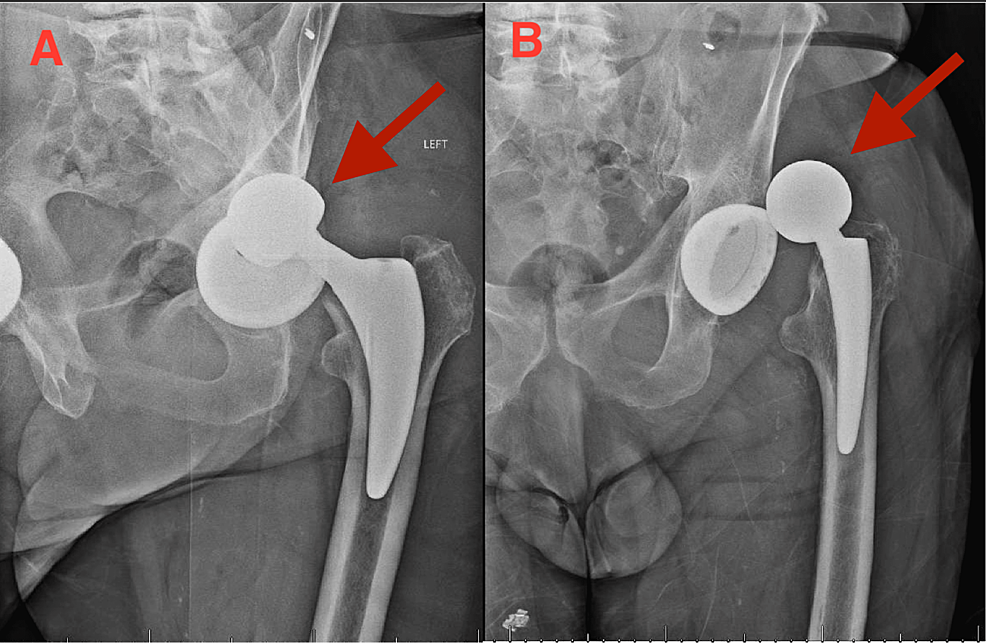 Cureus Near Complete Transection of the Sciatic Nerve After