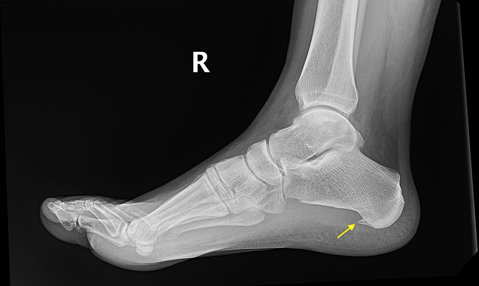 Nail in Foot, X-ray | Stock Image - Science Source Images