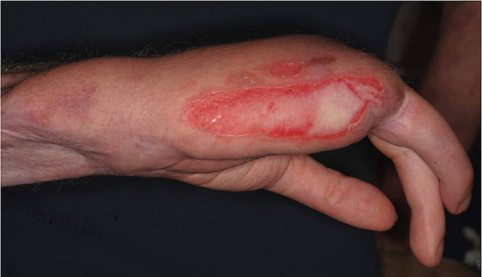 second degree partial thickness burn