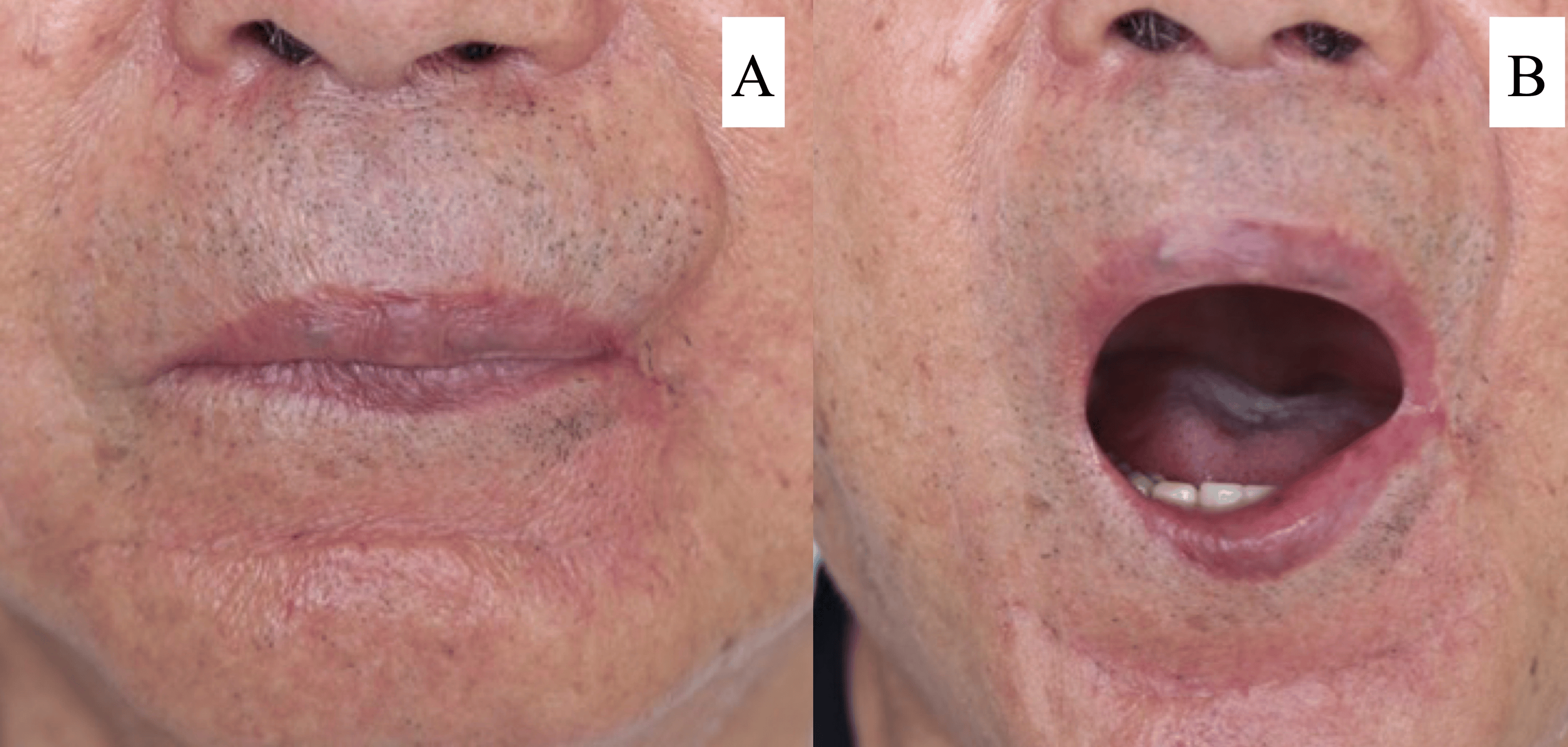Lower Lip Reconstruction Using the Karapandzic Flap Technique Cureus