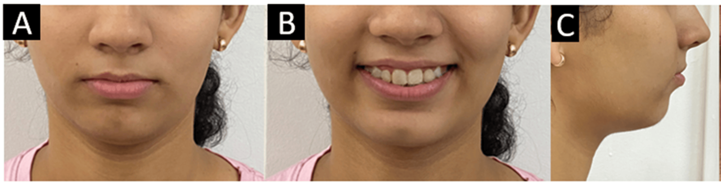 Cureus Simultaneous Intrusion and Retraction of Maxillary Anterior