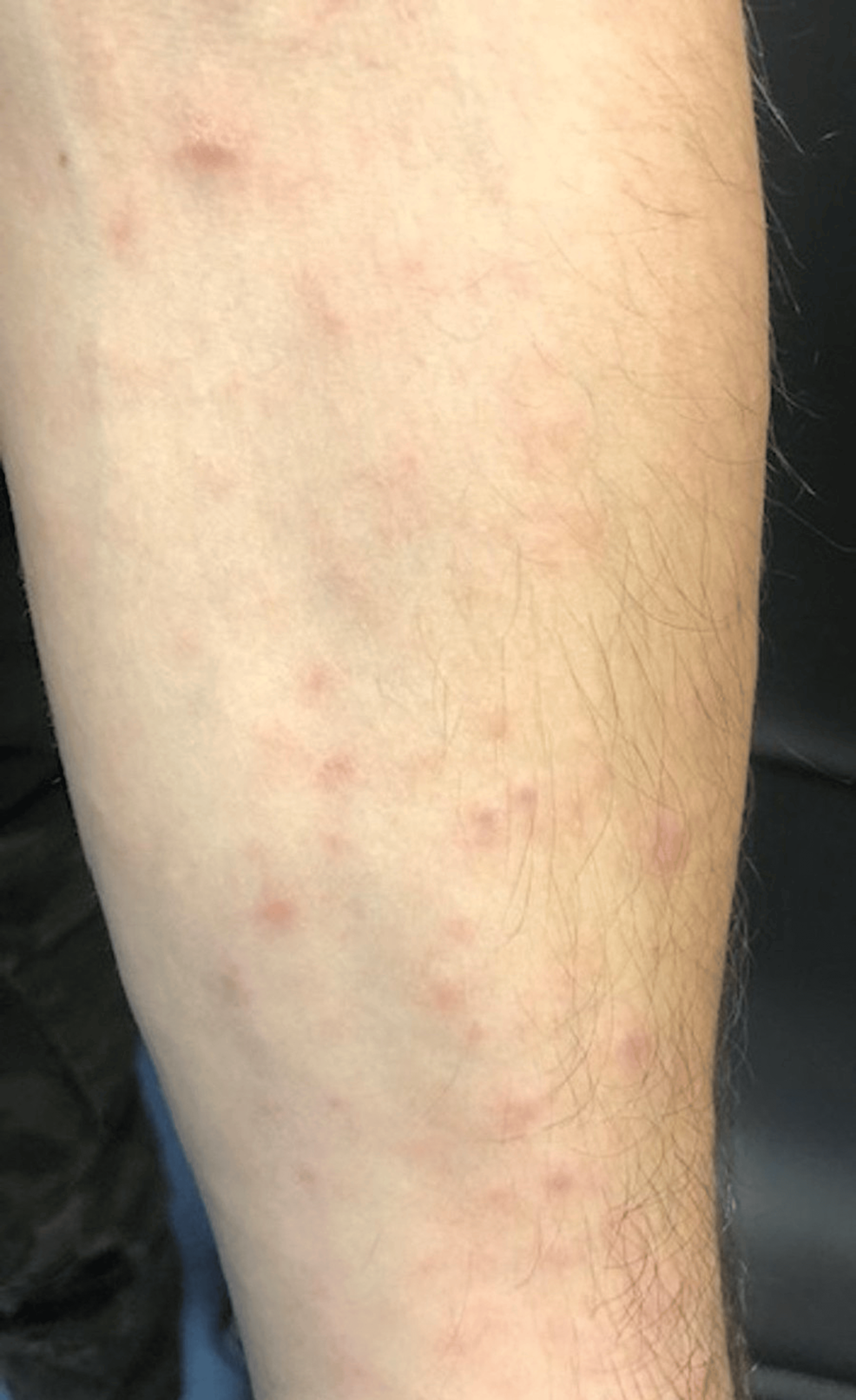 Cureus Cutaneous Eruption in a Crohn’s Disease Patient Under Tumor