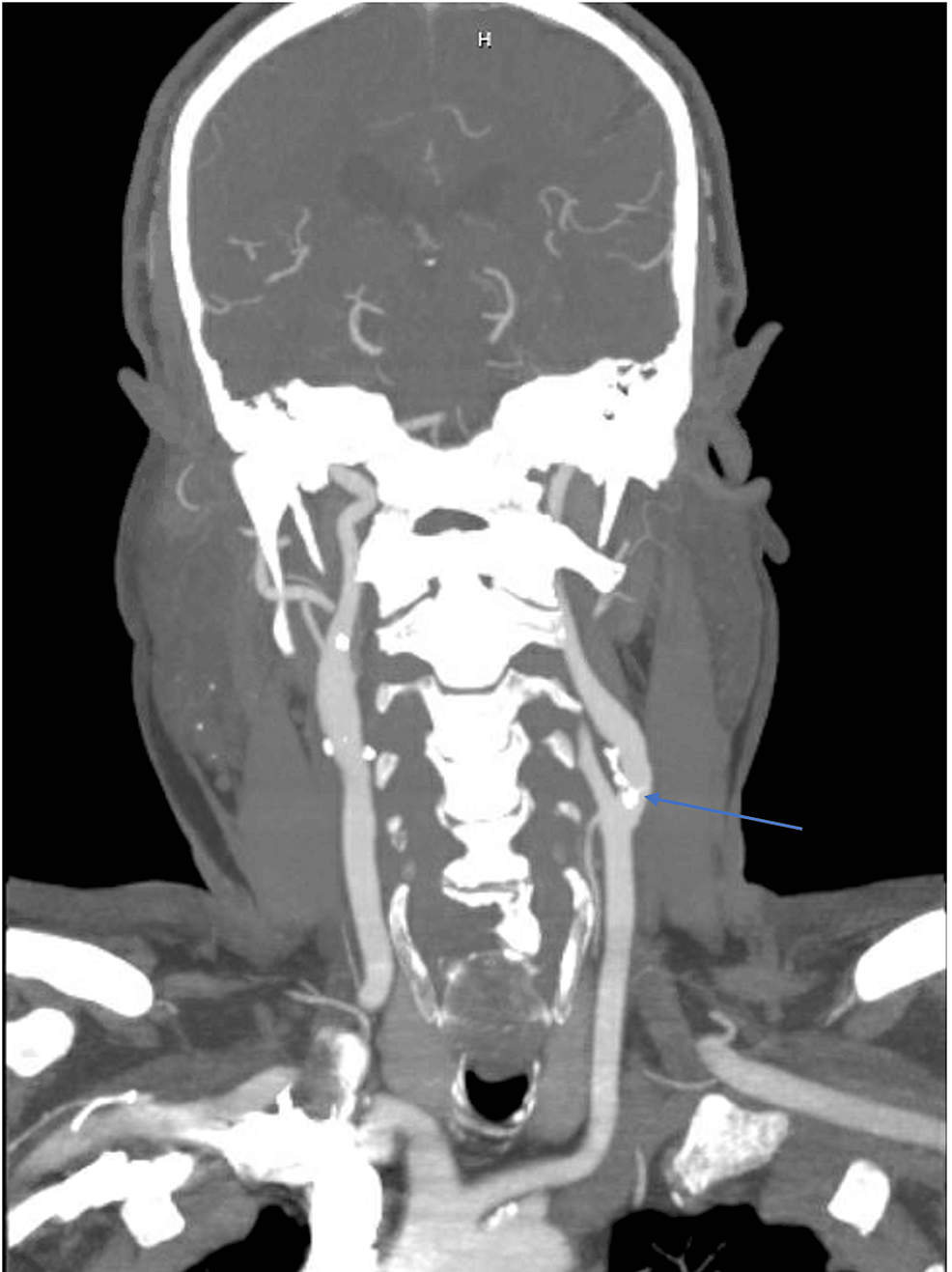 Mobile Atheroma in the Left Internal Carotid Artery: A Case of ...