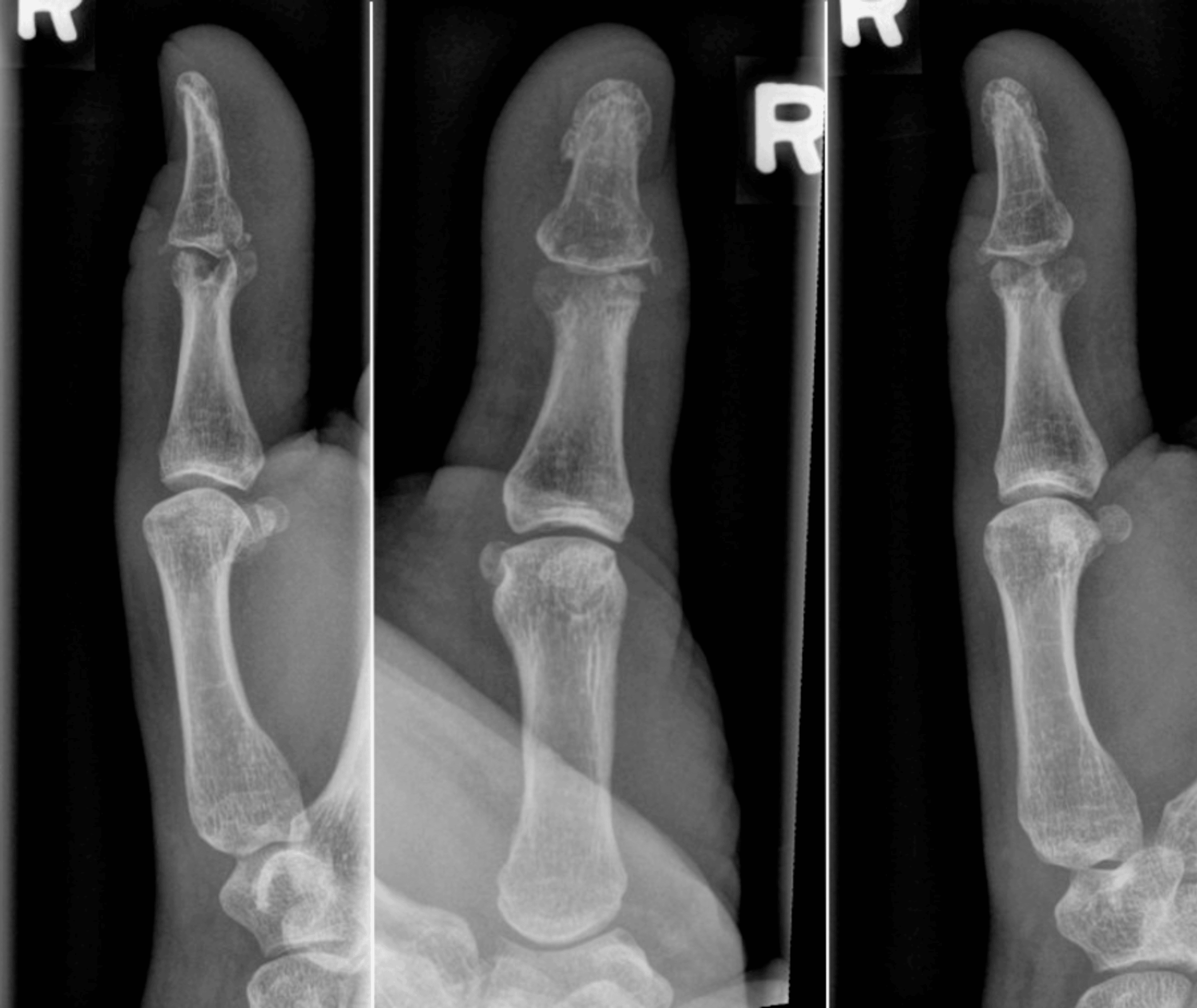 Second Toe Osteochondral Bone Graft for Resurfacing the Articular ...