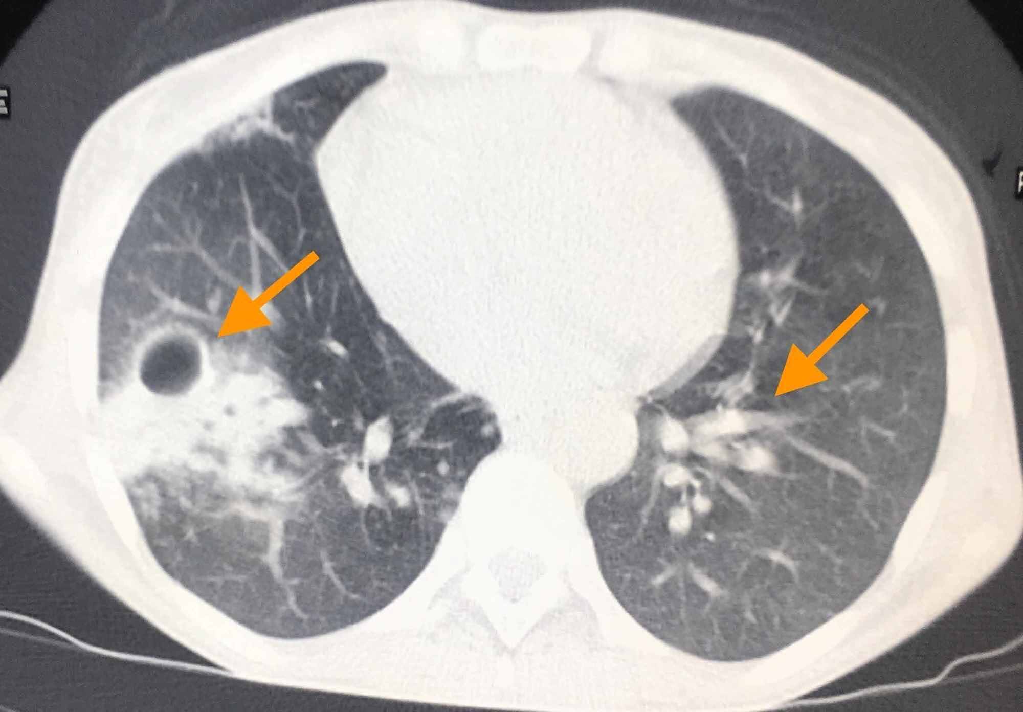 Cureus | Nontuberculous Mycobacterial Pulmonary Disease In An ...