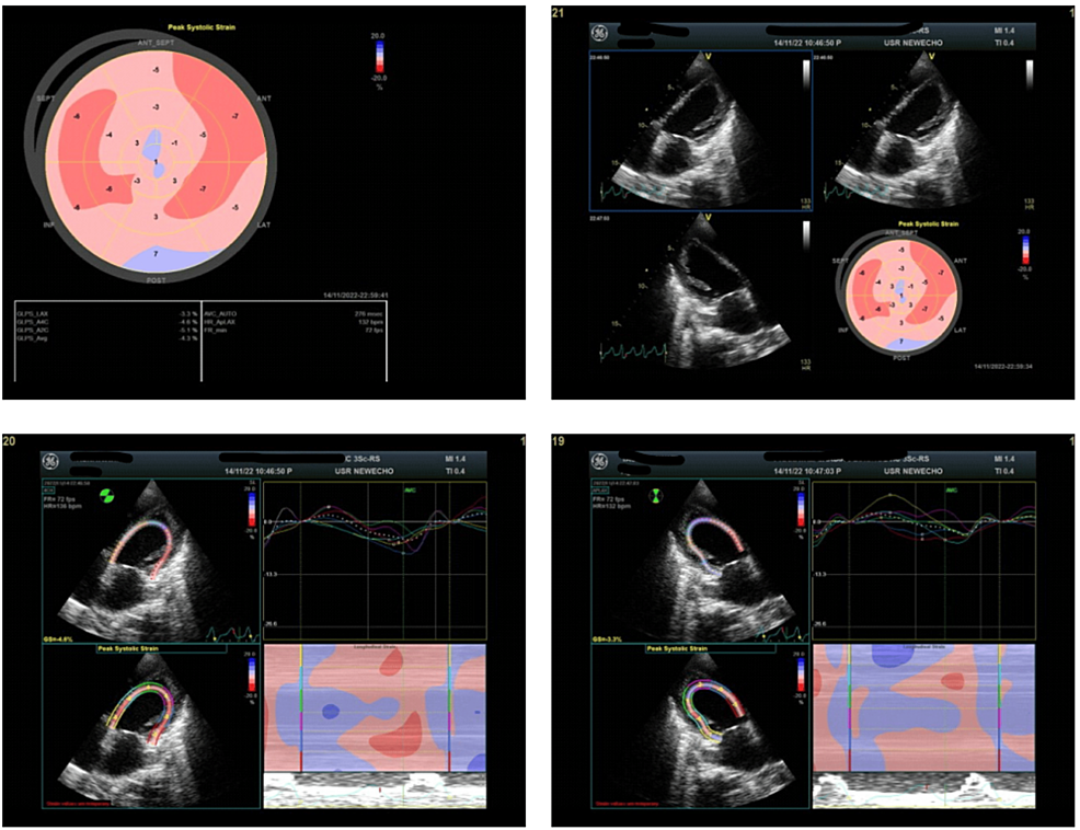 Peripartum Cardiomyopathy: A Case Series Emphasizing the Significance ...