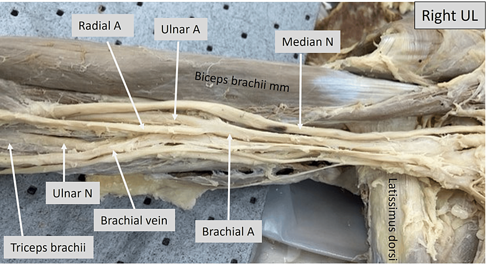 Cureus  Relationship of the Median and Radial Nerves at the Elbow