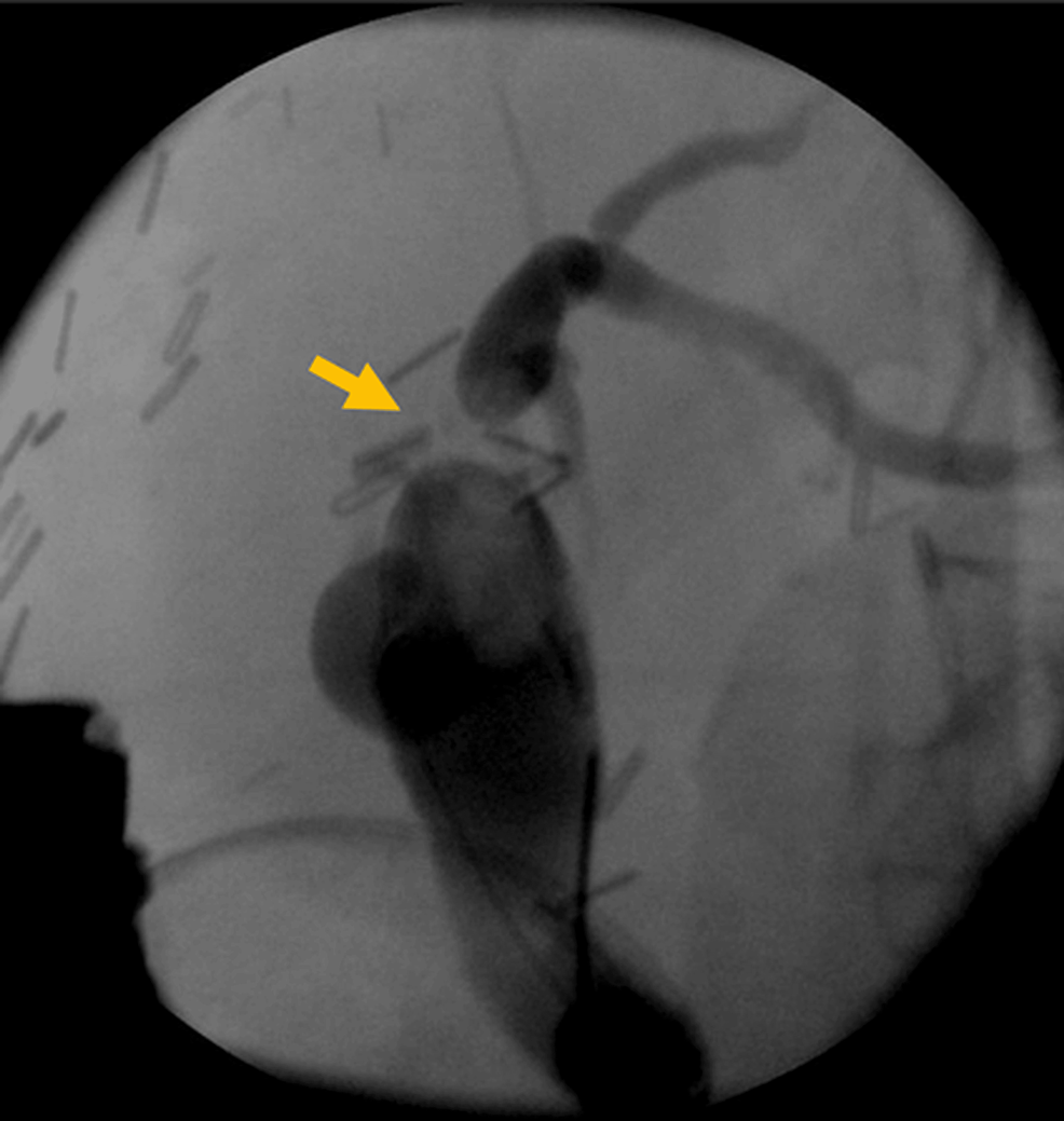 Innovative WaterWire Cannulation Technique for Managing Obstruction Due to Post