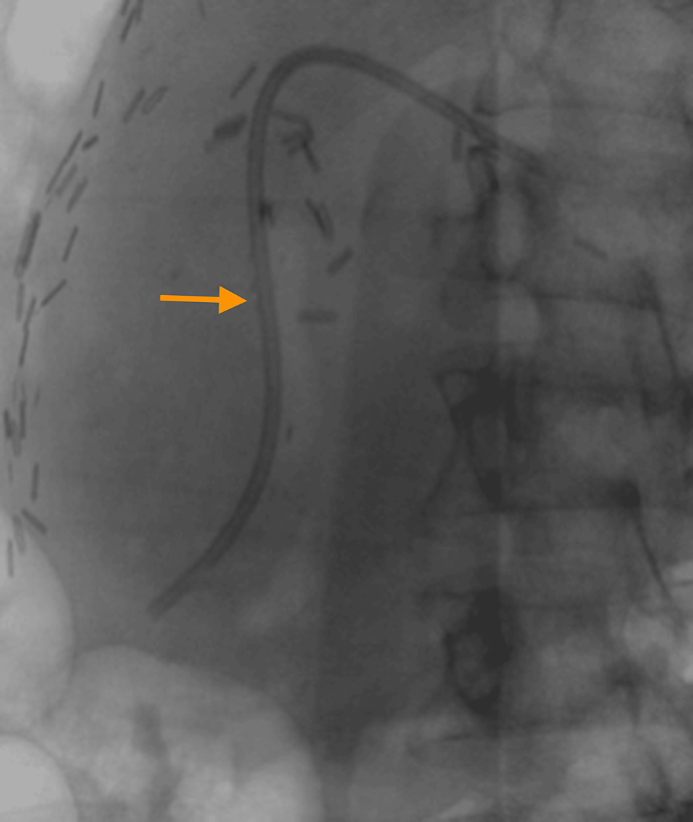 Innovative WaterWire Cannulation Technique for Managing Obstruction Due to Post
