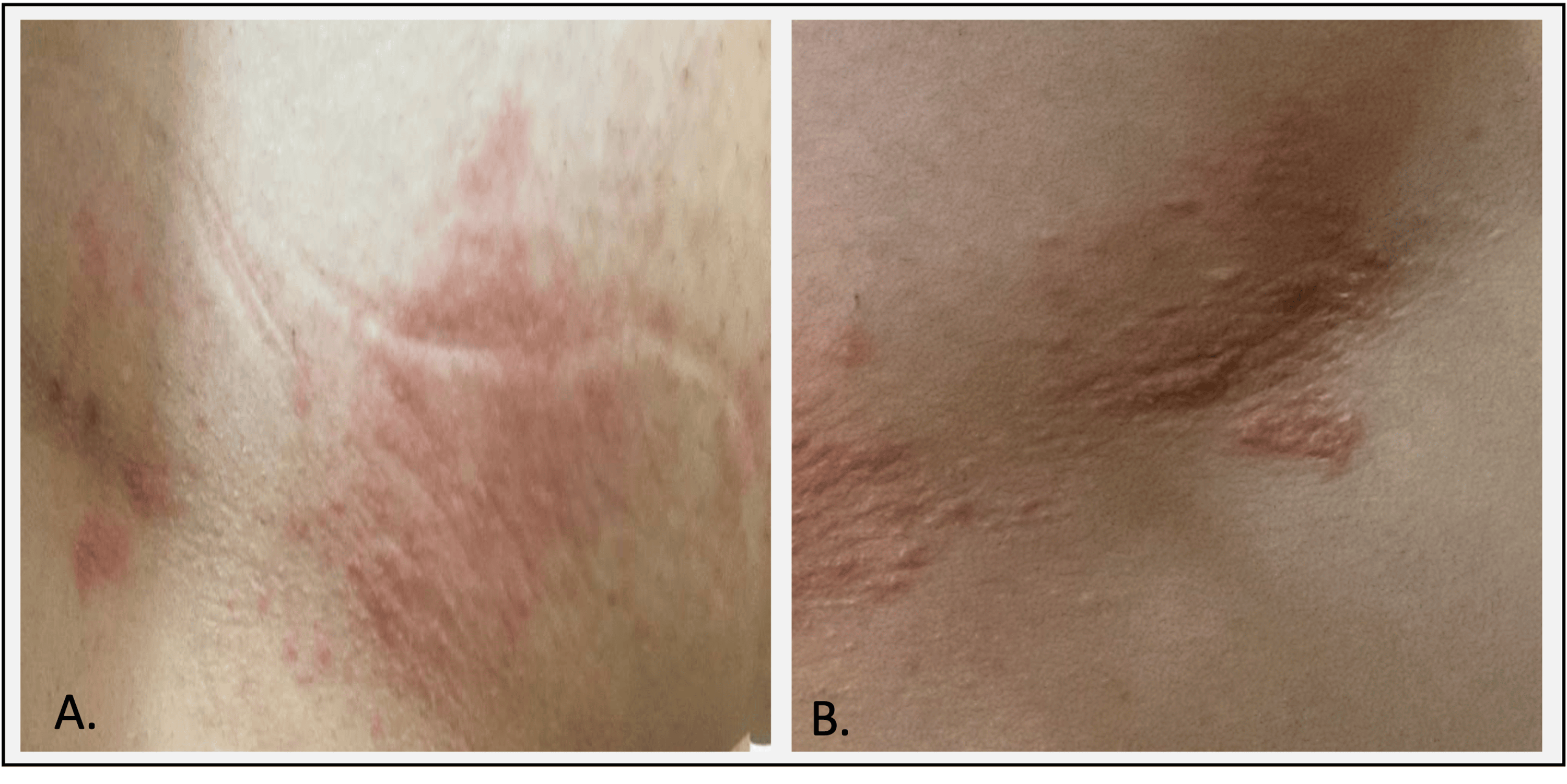 Reactivation of Herpes Zoster in a Young Patient With Multiple