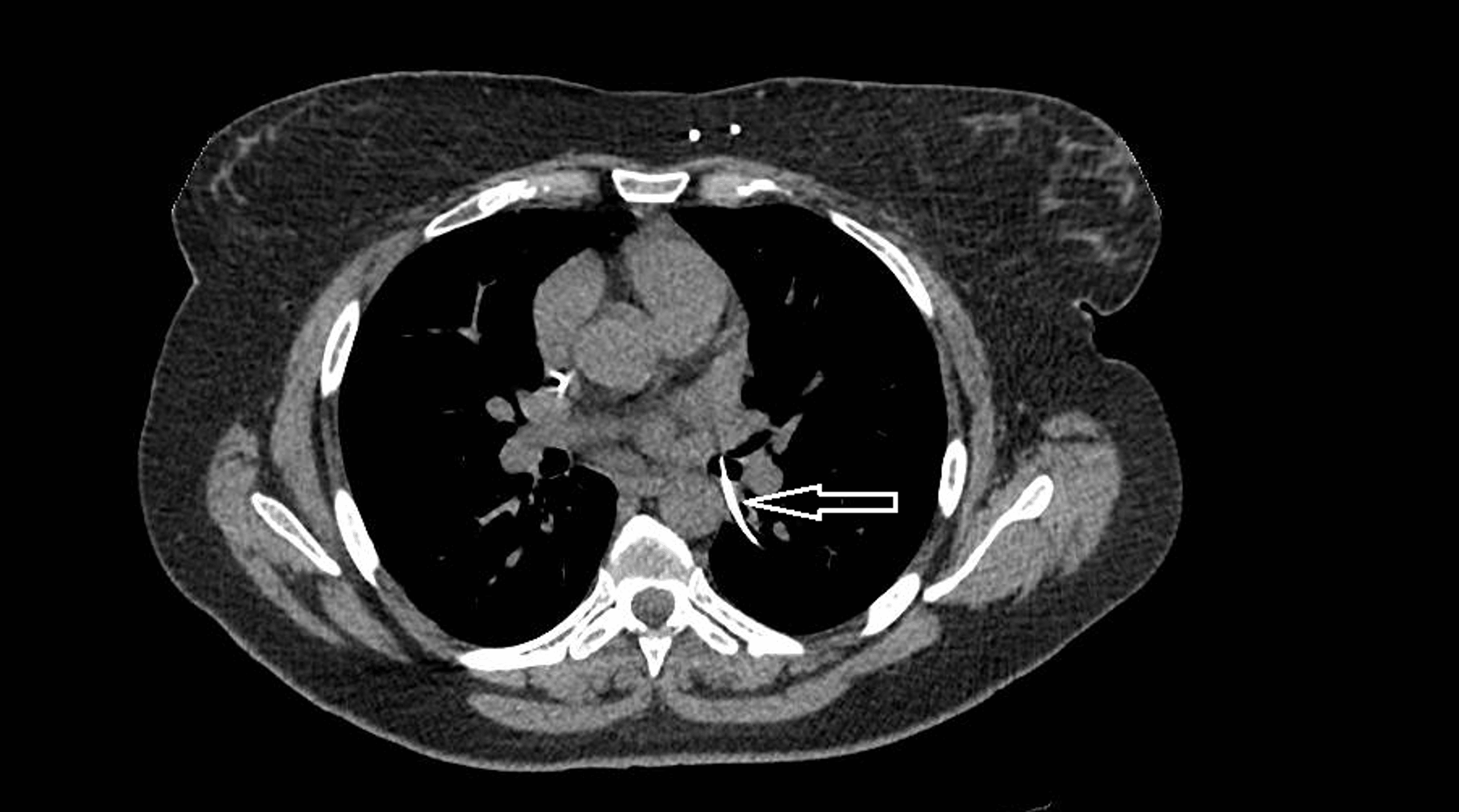 Cureus | a rare case of extraction of ventriculoperitoneal shunt from